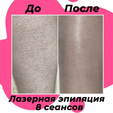 Полное отсутствие волос из-за 8 процедур 👍