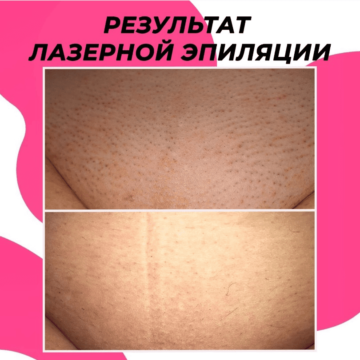 Первое фото до начала курса эпиляции, второе фото – через 4 процедуры 🔥